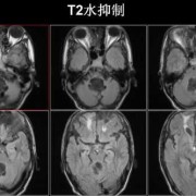 胎儿后颅窝是什么（后颅窝池吸收的高峰期是什么时候）