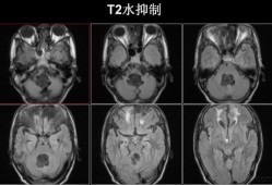 胎儿后颅窝是什么（后颅窝池吸收的高峰期是什么时候）