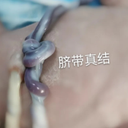 胎儿脐带打结（胎儿脐带打结是什么原因造成的）