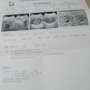 胎儿右肾囊性回声（胎儿右肾囊性回声）