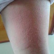 孕期痒疹（孕晚期起痒疹怎么办）