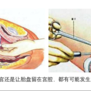 胎儿胎盘如何处理（胎盘有什么作用呢？生完孩子要留着吗）