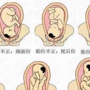 胎位RSA是什么意思，我不明白,孕期骶骨疼是怎么回事