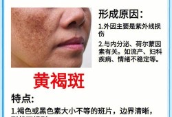 防止长斑的正确方法,孕期预防长斑的方法