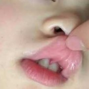 胎儿发黑（宝宝长牙的地方变黑了）