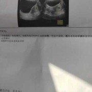 孕囊形态欠规则小孩能要吗,孕囊不规则胎儿能要吗胎芽正常