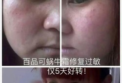 孕期脸上过敏怎么办,孕期脸部过敏怎么办