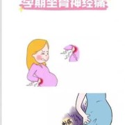 孕期坐骨神经痛的症状（孕期坐骨神经痛的症状）