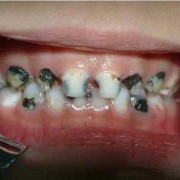 孕期蛀牙会影响胎儿吗？孕妇可以吃消炎药吗,蛀牙对胎儿有影响吗图片