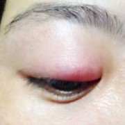 孕期眼疼（孕期眼疼是什么原因）