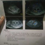 双胞胎孕期（双胎一大一小正常吗）