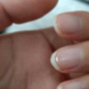 孕期长白斑（指甲上有白斑是怎么回事）