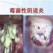 霉菌性阴道炎对胎儿有影响吗（白带念珠菌对胎儿的影响）