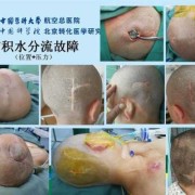 造成胎儿脑积水的原因（孕妇羊水过多会引起胎儿脑积水吗）