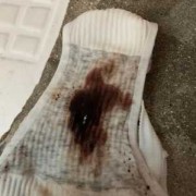 怀孕期间流了一点血（大姨妈来了只有一点点是怎么回事）
