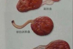 球状胎盘对胎儿的影响（球状胎盘对胎儿的影响）