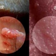 怀孕期间外阴长了疙瘩（孕晚期阴部长了一堆像水泡的疙瘩，怎么回事）
