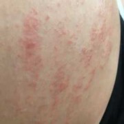 孕期肚皮红点（孕妇肚子上起红点还痒怎么办最好）