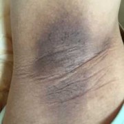 怀孕期间胳肢窝变黑（怀孕期间胳肢窝变黑怎么回事）