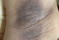 怀孕期间胳肢窝变黑（怀孕期间胳肢窝变黑怎么回事）