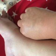 孕期手肿原因（孕期手肿原因有哪些）