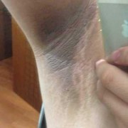 孕期腋窝黑（怀孕腋下变黑怎么办）