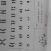 无创胎儿染色体检查（无创检查出性染色体异常怎么办）