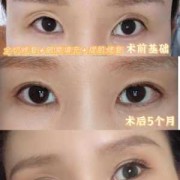 胎儿眼窝深（胎儿眼窝深是不是眼睛就大）