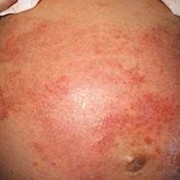治疗孕期湿疹小妙招（治疗孕期湿疹小妙招有哪些）