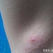 孕期淋巴长痘（怀孕后腋窝下有肉疙瘩是怎么回事）