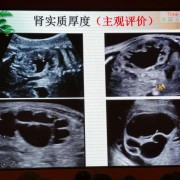 胎儿肾盂分离做了引产（胎儿肾盂分离做了引产有影响吗）