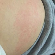 孕期肚皮瘙痒（孕期肚皮瘙痒起红点）