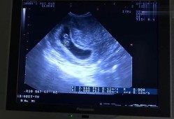 孕6周有胎心b超形状不规则,胎儿形态不规则是什么意思