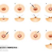 孕期乳头内陷怎么办？这是什么情况啊,孕期乳头矫正器矫正凹陷乳头流水是怎么回事 怎么办