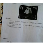 胎儿没有胎心（胎儿没胎心是什么原因，是什么原因导致的呢）