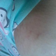 孕期乳房周围斑点（孕期乳房周围斑点怎么回事）