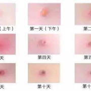 孕期出水痘（孕妇三个月了起水痘发烧39度多怎么办）