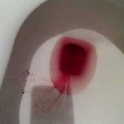 孕期会出血吗（孕妇乳头出血是怎能么回事）