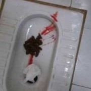 孕期肛门滴血（孕期肛门滴血不痛血色鲜红）