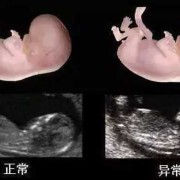 胎儿排畸（胎儿排畸检查有哪些）