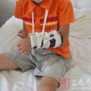 骨折都有哪些表现,胎儿骨折有什么症状表现
