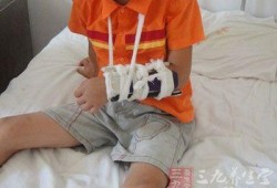 骨折都有哪些表现,胎儿骨折有什么症状表现