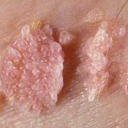 尖锐湿疣对胎儿影响吗（得了尖锐湿疣怀孕可以吗）