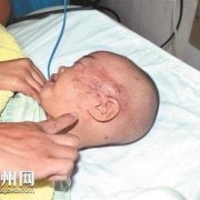 宝宝在宫内挤压左脸变形会好吗,胎儿头挤变形