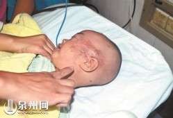 宝宝在宫内挤压左脸变形会好吗,胎儿头挤变形
