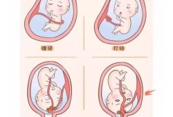 胎儿绕颈是男孩吗（胎儿绕颈是男孩吗还是女孩）