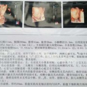 胎儿神经管缺陷（胎儿神经管缺陷做什么检查）