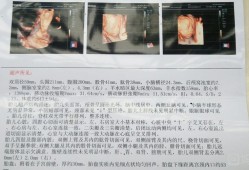胎儿神经管缺陷（胎儿神经管缺陷做什么检查）