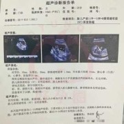 孕妇可以憋尿吗,胎儿憋尿B超会出现什么结果