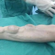 孕期胸部血管明显（乳房上的青色血管很明显是怎么回事呀）